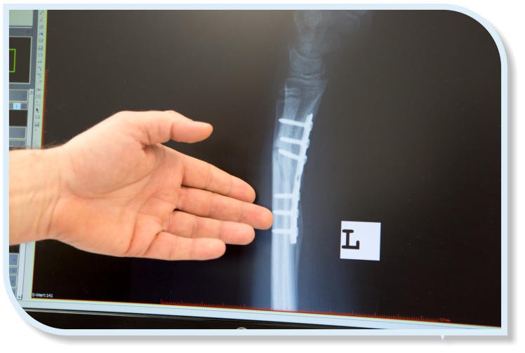 Eine Hand zeigt auf eine Röntgenaufnahme eines menschlichen Unterarms, auf dem eine chirurgische Platte mit Schrauben zur Stabilisierung eines Knochens sichtbar ist.